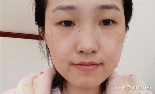 激光祛斑视频全过程,安全高效，美丽蜕变